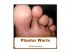 Plantar Warts by Miriam Kinai