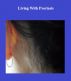 Living With Psoriasis by Monica P