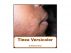 Tinea Versicolor by Miriam Kinai