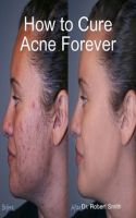 Cover for 'How to Cure Acne Forever'