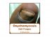 Onychomycosis or Nail Fungus Infection by Miriam Kinai