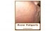 Acne Vulgaris by Miriam Kinai