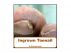 Ingrown Toenails by Miriam Kinai
